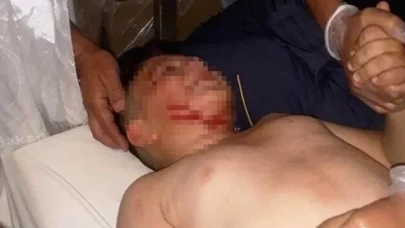 Sahipsiz köpeğin saldırdığı çocuğa 40 dikiş atıldı