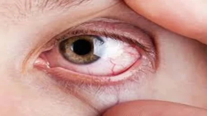 Dikkat! Bu hastalık 80 milyon kişide görülüyor!