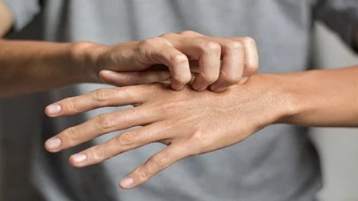 Uyuz vakalarında artış !