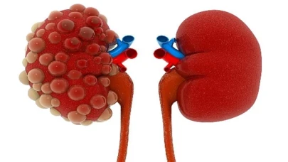 Polikistik böbrek hastalığı yavaş gelişir, her şey hızla değişir