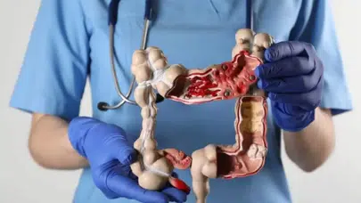 Kolon kanserine davetiye çıkaran tehlikeli alışkanlıklar