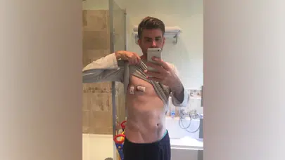 Erkeklerde meme kanseri uyarısı