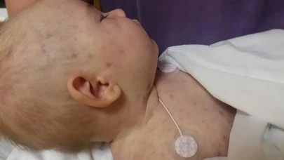 Bebeklerde meningokok bakterisine dikkat! Ciddi enfeksiyonlara neden olabiliyor