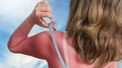 Kısa tatilde güneş yanığına dikkat: Cilt kanseri riski artıyor