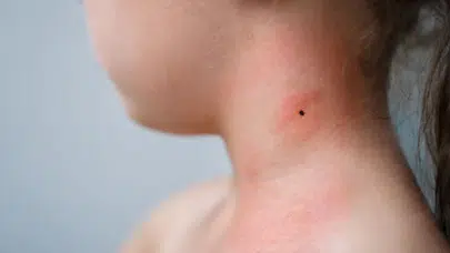 Lyme hastalığı nedir, belirtileri nelerdir? Bella Hadid'in hastalığı Lyme'nin tedavisi var mı?