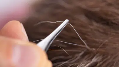 Erken beyazlayan saçlar hangi hastalıkların habercisi?