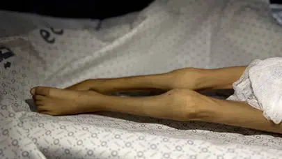 BM’den Gazze uyarısı: Açlık ölümleri ‘sıradanlaştı’, sağlık sistemi yok ediliyor