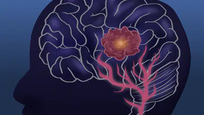 İngiliz araştırmacılar Glioblastoma’yı erken aşamada durdurmanın yolunu buldu