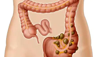 Ülseratif kolit nedir, belirtileri neler?