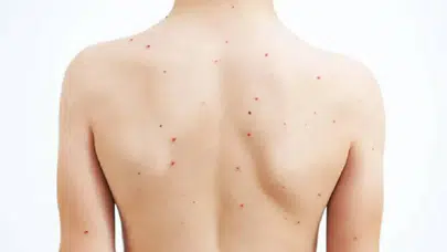 Okullarda suçiçeği alarmı: Uzmanlardan ailelere kritik uyarı