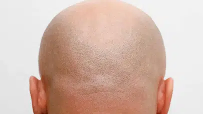 Kelliğe karşı umut veren keşif: Binlerce yıllık bitki saç kökü hücrelerini koruyabilir