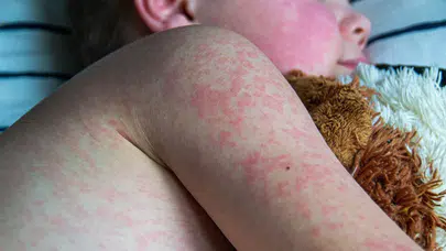 Okullarda suçiçeği alarmı: Uzmanlar döküntü öncesi bulaşmaya karşı uyardı