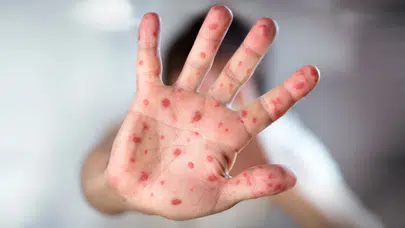 ABD'de kızamık alarmı: Dr. Mehmet Oz'dan "Aşı olun" çağrısı