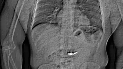 Florida’da lüks mücevher mağazasından çalınan 769 bin dolar değerindeki küpeleri yutan şüpheli gözaltına alındı