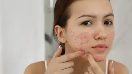 Dünyada bir ilk: Sivilce aşısı geliştirildi