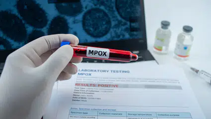 Gana’da M çiçeği virüsü kaynaklı ilk ölüm gerçekleşti