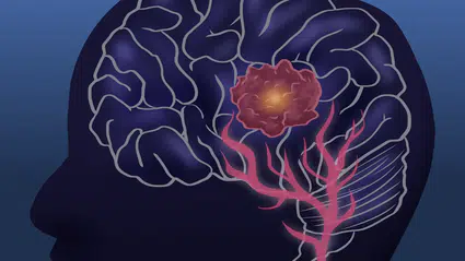 İngiliz araştırmacılar Glioblastoma’yı erken aşamada durdurmanın yolunu buldu