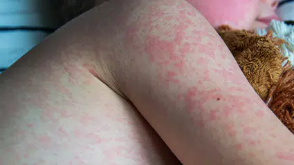 ABD’de kızamık salgını büyüyor: 600’ü aşkın vaka bildirildi