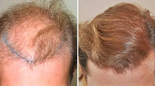 3000 Greft Saç Ekimi Kaç Ayda Sonuç Verir?