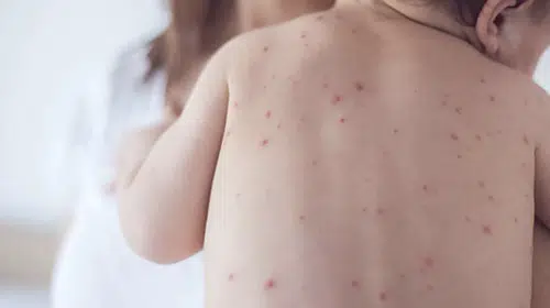 Bangladeş'te kızamık salgını: 6 haftada 113 çocuk hayatını kaybetti