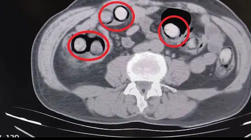 Tatvan'da yolcu otobüsünde yakalandı: Midesinden 758 gram metamfetamin çıktı