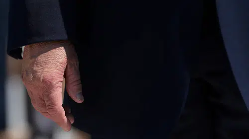 Trump’ın moraran elindeki makyaj dikkat çekti