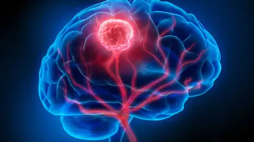 Glioblastoma tedavisinde umut veren keşif: Kanser hücrelerinin kalkanı kırıldı