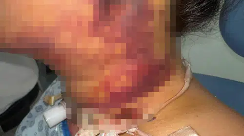 Estetik operasyon kabusa dönüştü: Yoğun bakımlık olan hastadan 5 milyonluk dava