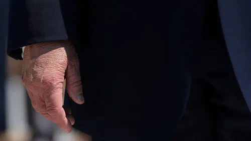 Trump’ın moraran elindeki makyaj dikkat çekti