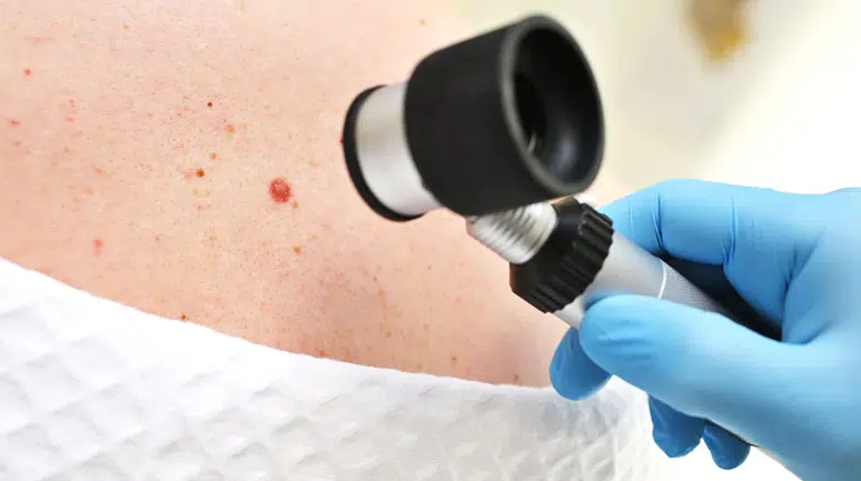 HPV’nin yeni türü cilt kanserine neden olabilir: Bilim insanlarından çarpıcı keşif