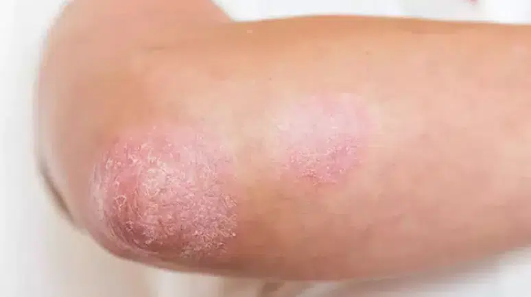 Sedef hastalığında kritik keşif: Bağışıklık hücrelerini yönlendiren gizli şeker tabakası bulundu