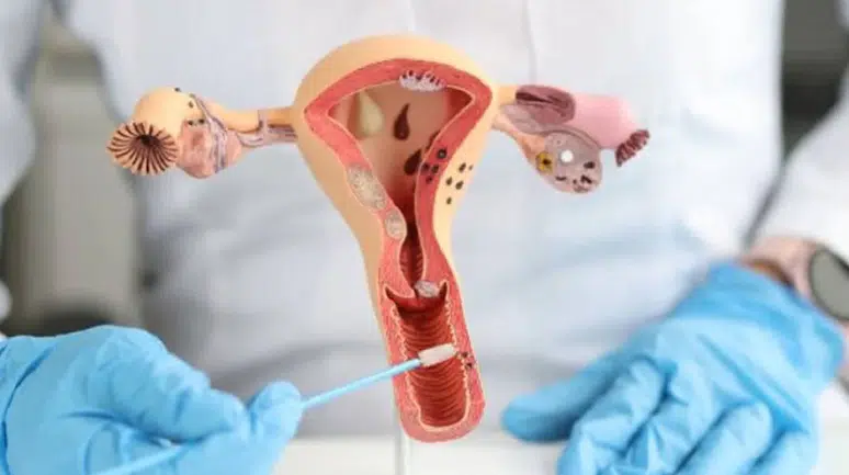 Çikolata kisti farkındalığı hayati: Nefes darlığı ve organ hasarı riski var