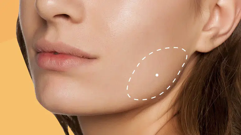 Masseter Botoks: Kalıcı mı, Geçici mi?