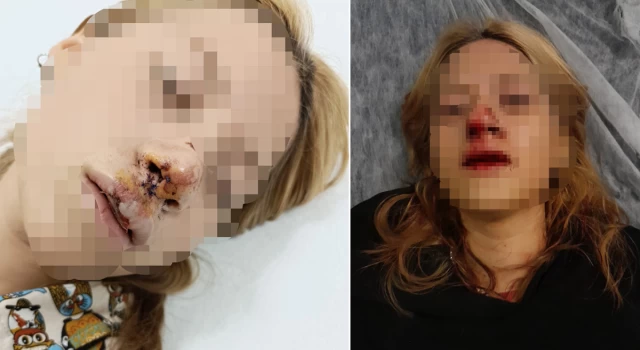 Sultangazi’de genç kızın yüzüne kaldırım taşı atıp, dişlerini kırdılar: Yardıma gelen arkadaşının kulağını kestiler