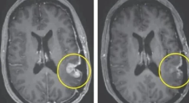 Beyin tümörünü beş gün içinde yok edebilen bir tedavi bulundu