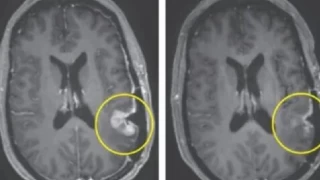 Beyin tümörünü beş gün içinde yok edebilen bir tedavi bulundu