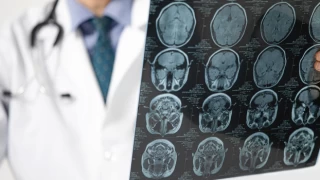 Dünyada bir ilk: Yeni beyin kanseri tedavisi başarılı oldu