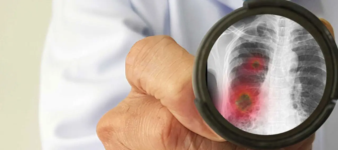 Ateşsiz zatürre nedir, belirtileri nelerdir ve nasıl tedavi edilir? 2