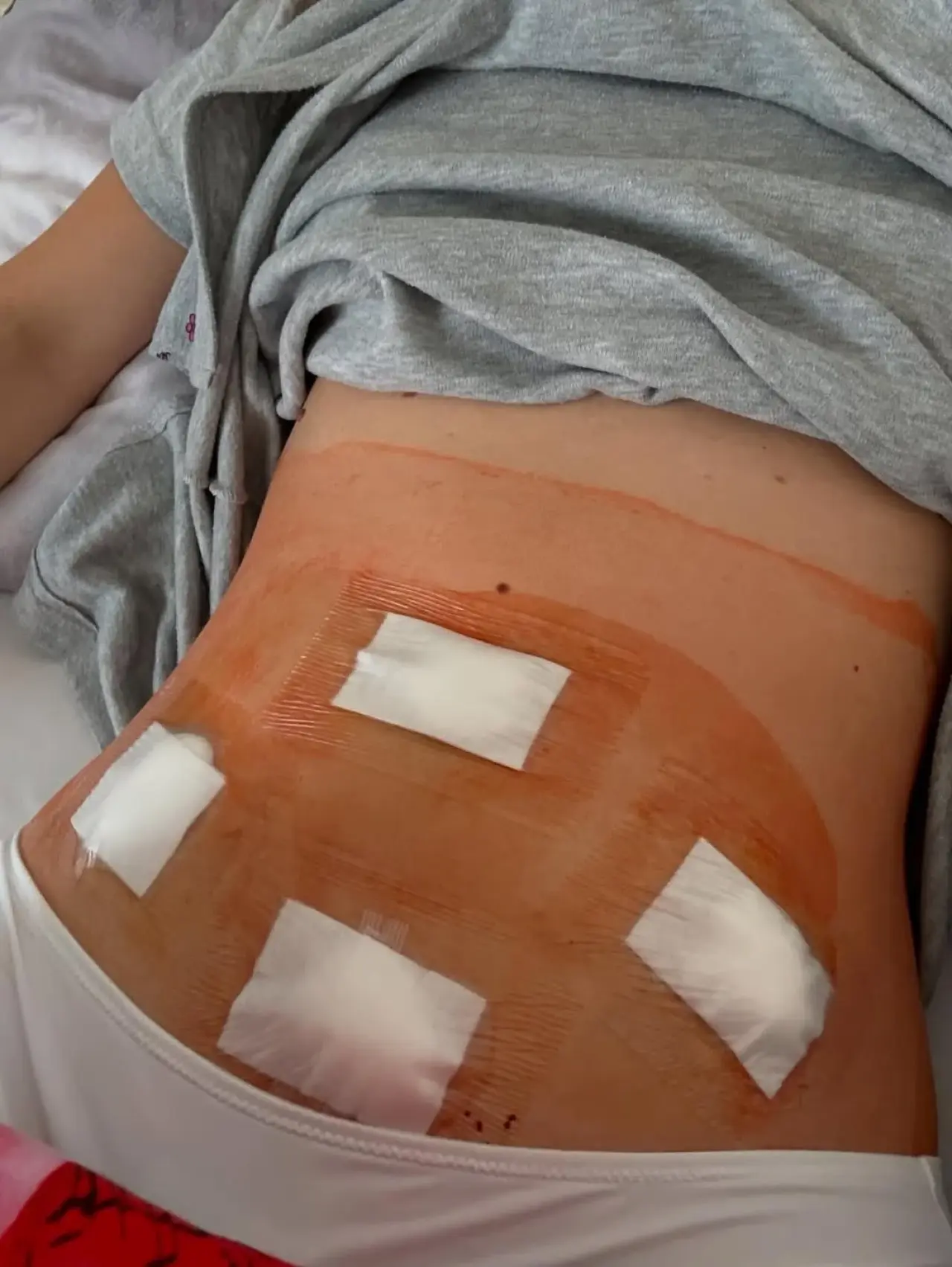 Süper model Barbara Palvin, endometriozis teşhisini ve ameliyat sürecini paylaştı 2