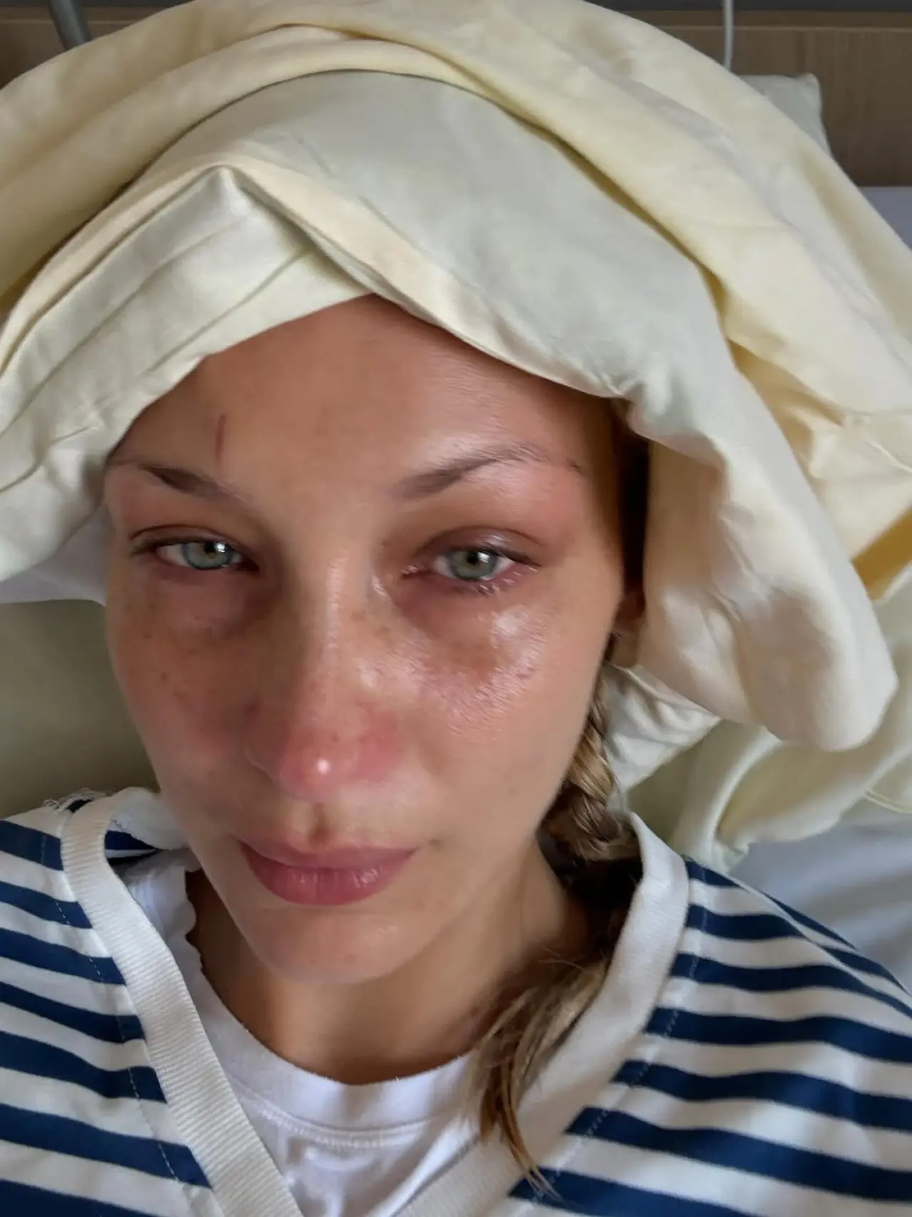 Bella Hadid, Lyme hastalığıyla mücadelesini paylaştı: Hep ortadan kayboluyorum 4